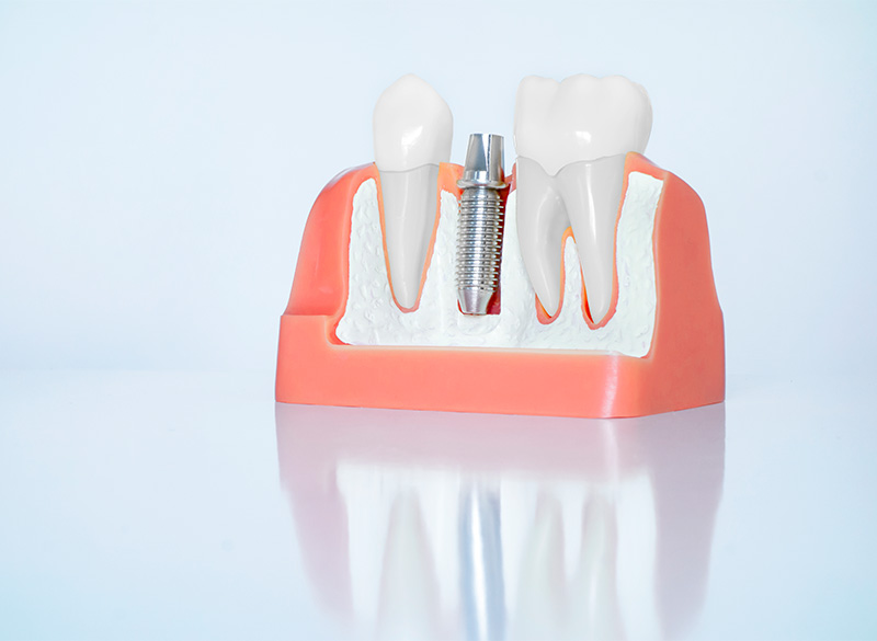 インプラント