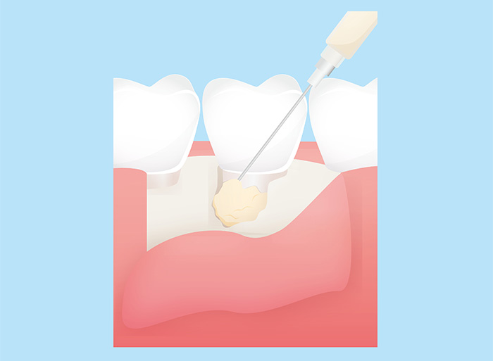 リグロス・エムドゲイン（一部自由診療）