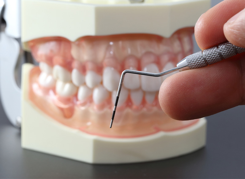 歯周組織再生療法