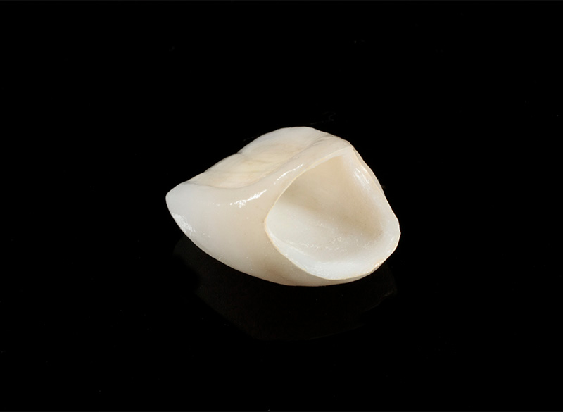 自由診療のセラミックと保険診療の銀歯の違い